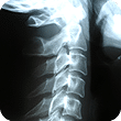 X-ray image of a spine for identifying misalignments and degeneration
