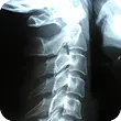 X-ray image of a spine for identifying misalignments and degeneration