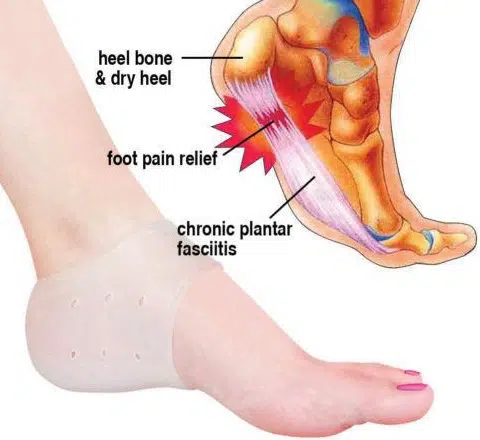 Plantar Fasciitis Treatment in The Woodlands