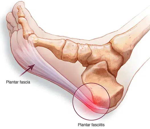 Plantar Fasciitis Treatment in The Woodlands