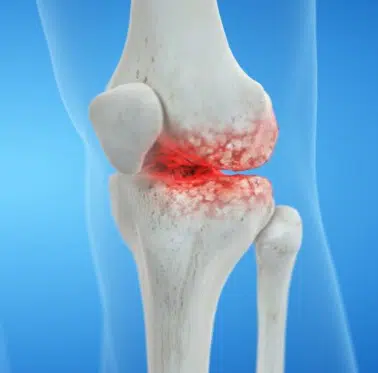 knee Arthritis-knee pain treatment