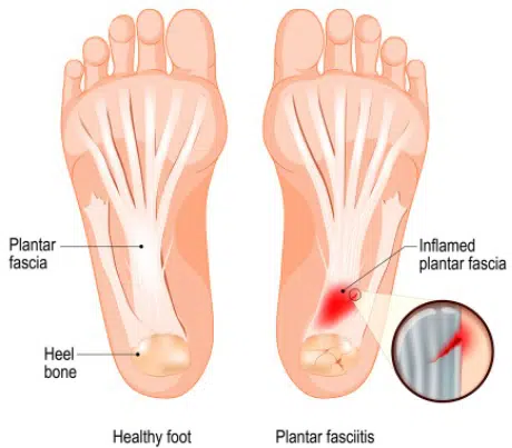 Illustration of a pair of feet with labels pointing to Plantar fascia and Heel bone in the healthy foot, and the foot on the right with Plantar fasciitis