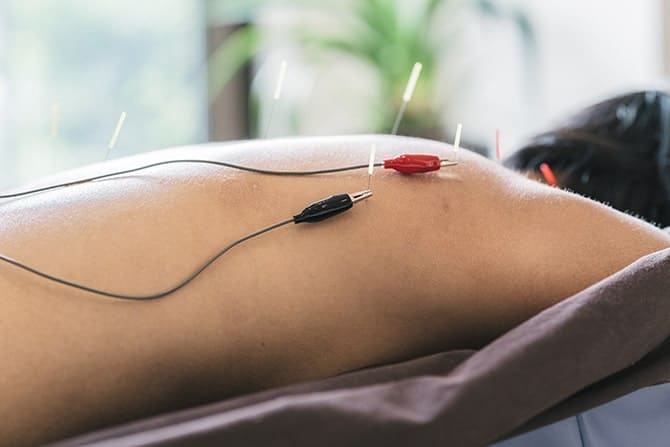 back of a patient's back getting dry needling treatment