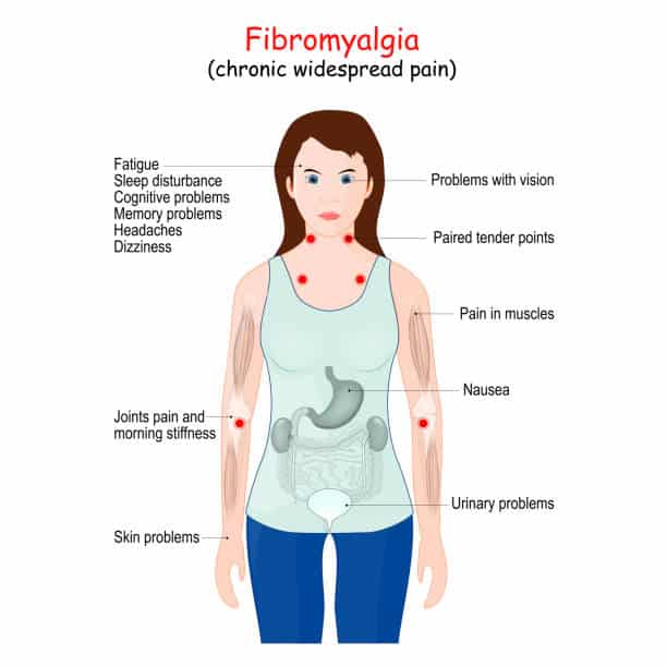 Fibromyalgia sign and symptoms disease illustration chart.