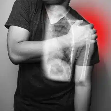 Image of a Man who suffers from Shoulder dislocation.