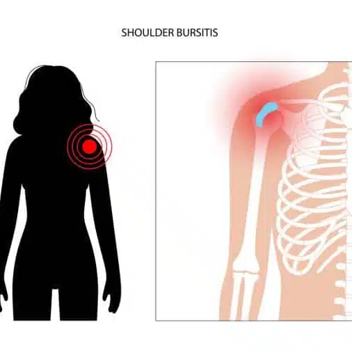 Medical Illustration of Shoulder bursitis.