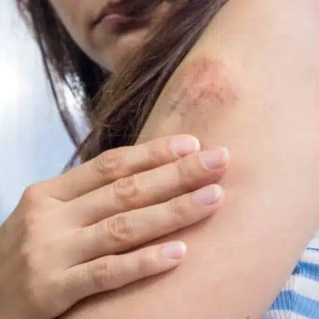 Woman having bruises on her shoulder feeling of pain.