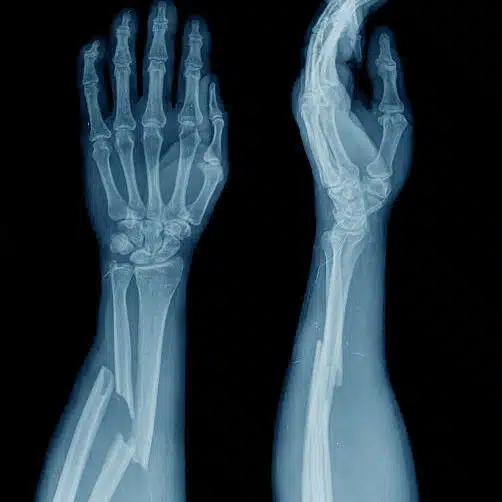 Medical 3D X-ray of a broken arm.