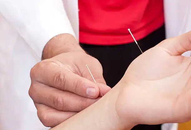 Acupuncture for Carpal Tunnel Syndrome.
