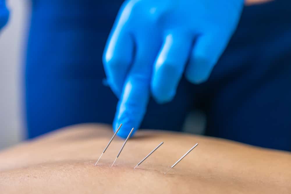 dry needling on skin of patient