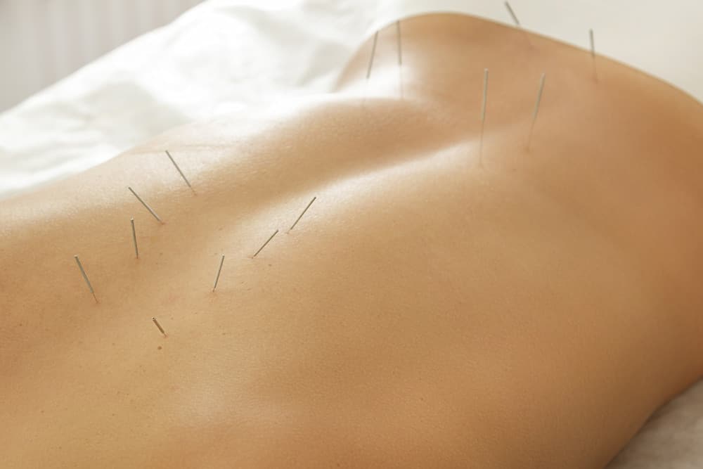 acupuncture needles on womans back to relieve muscle tension