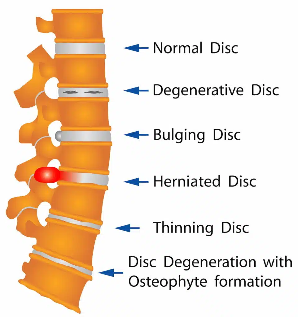 Back bone parts